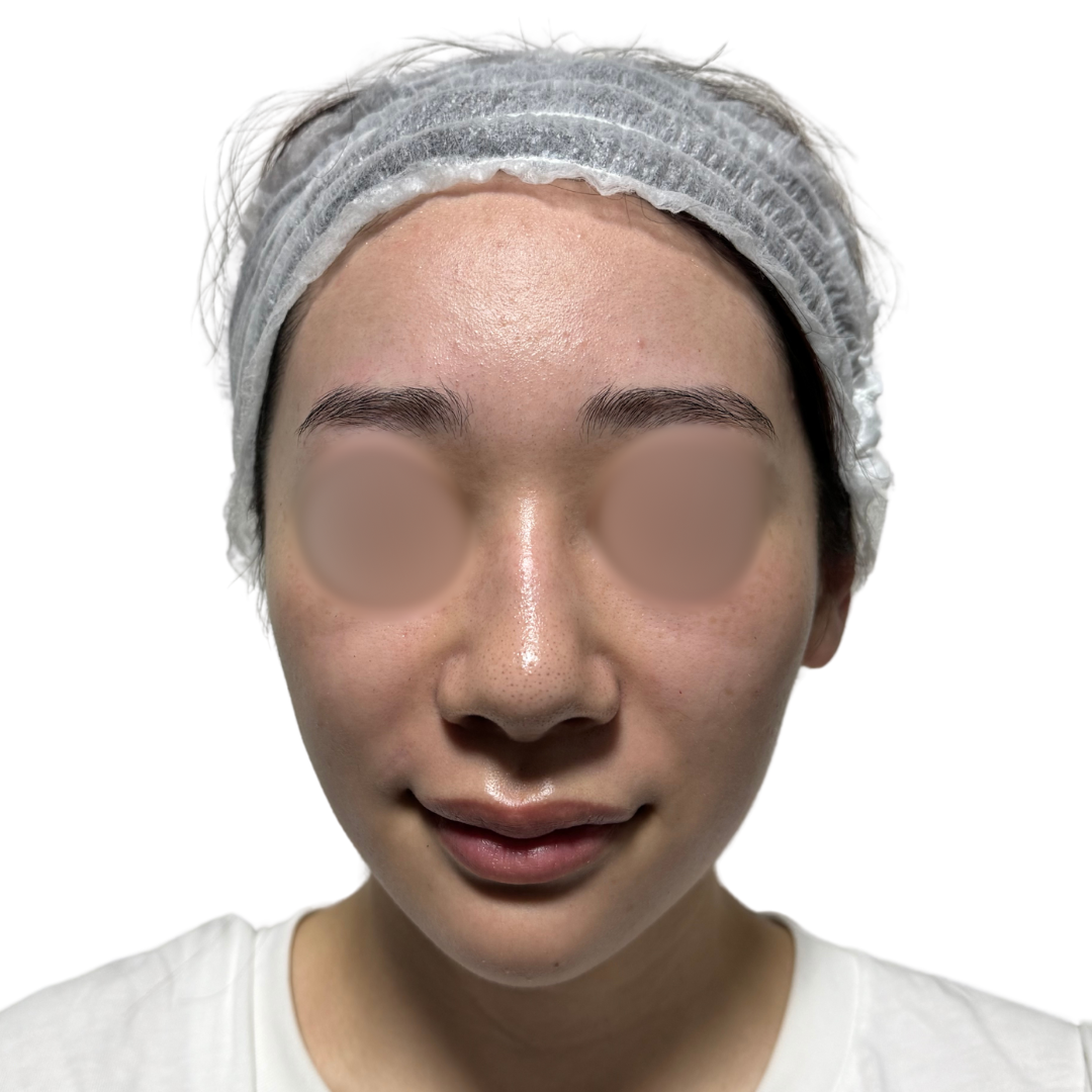 水光注射（スキンブースター）